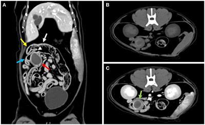 Case report: Surgical management of ileal duplication cyst in a cat: a case report and review of the literature